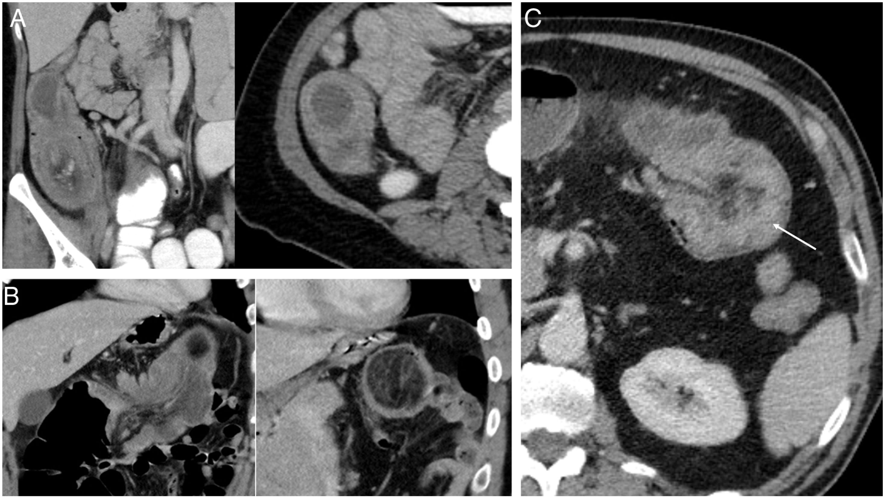 Intestinal intussusception in adults: Location, causes, symptoms, and ...