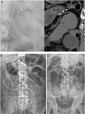Plain radiography. A) "Crescent sign