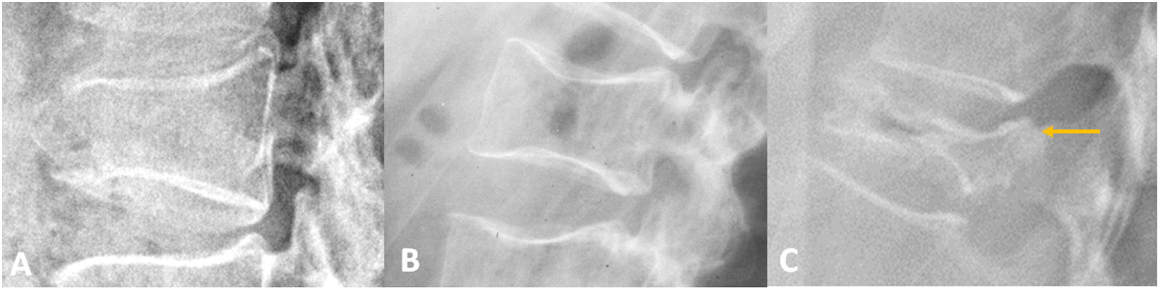 Pattern Deformity Imaging of low-energy vertebral fractures | Radiología (English Edition)