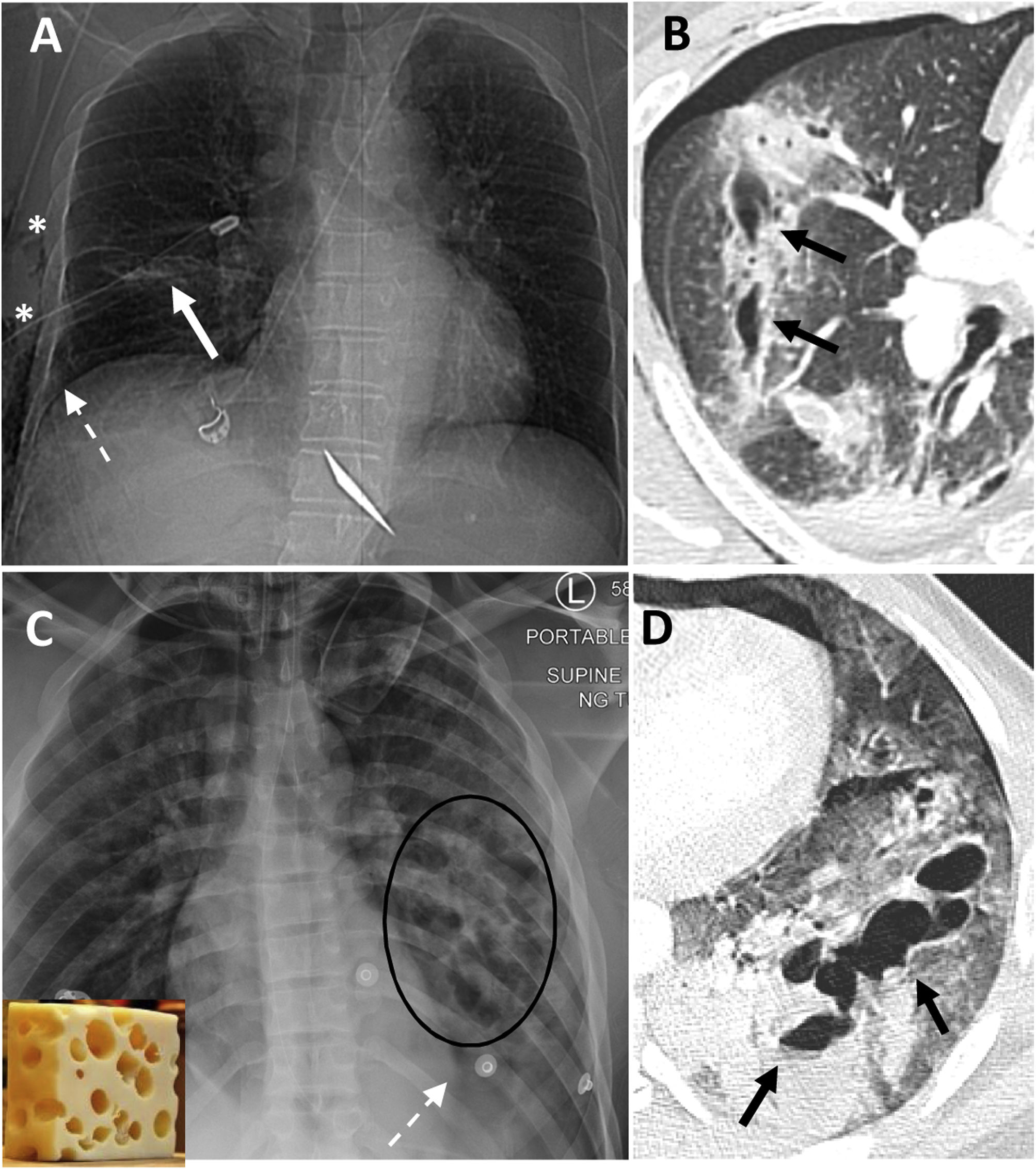 Severe non-cardiovascular thoracic trauma: diagnostic clues on computed ...