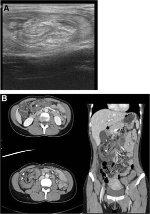 Role of imaging in the evaluation of intussusception in adults: A 10 ...
