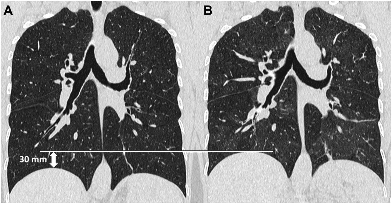 Expired Line Scan Expiratory CT scan: When to do it and how to interpret it | Radiología ...