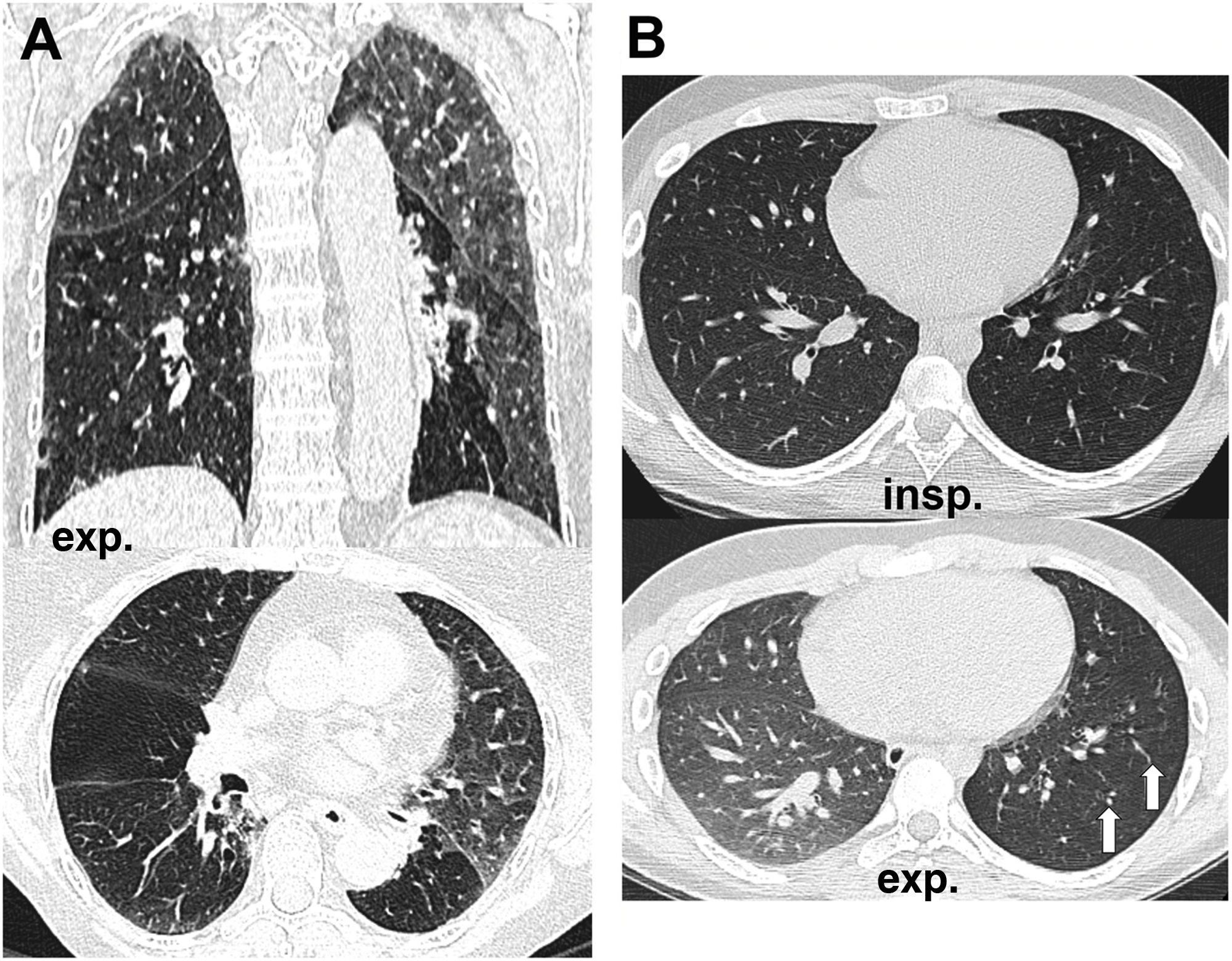 Expiratory CT scan: When to do it and how to interpret it | RadiologÃa ...