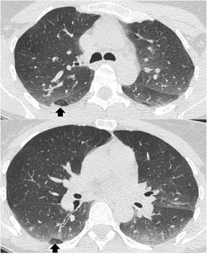Axial CT scan at the level of the carina and lower lobes during expiration in an asymptomatic patient with normal PFTs, showing two low-density secondary lobules in the posterior area of the right lower lobe (arrows), which correspond to physiological lobular air trapping.