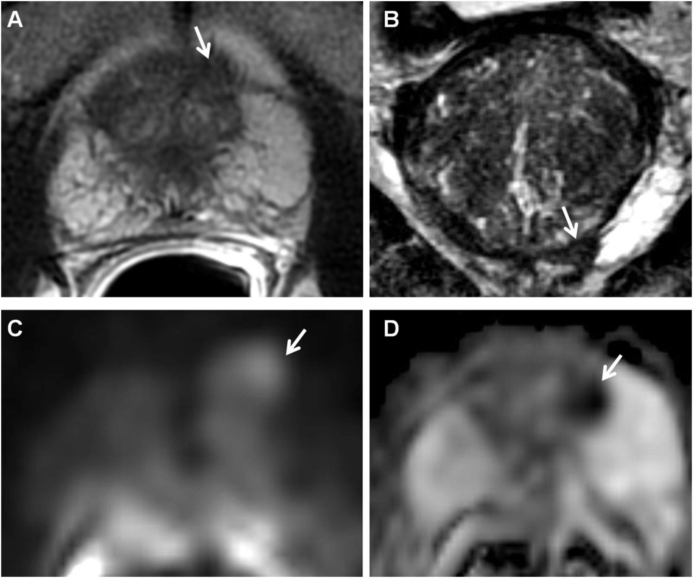 MRI for detection, staging, and follow-up of prostate cancer: Synthesis ...
