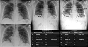 Patient with low-grade fever, myalgia, general malaise and a week of evolution with positive RT-PCR for SARS-CoV-2 and pneumonia visible on the chest X-ray (CXR) in posteroanterior projection, obtained on consecutive days (a and b) and detected with the GE Healthcare Thoracic Care Suite tool (which incorporates Lunit Insight CXR) (c and d). The lungs are divided into 6 fields by manually drawing a line that crosses the lower edge of the aortic arch (*) and another (**) which divides the lung below the first one into 2 upper-lower parts as similar as possible in size. The area of consolidation detected by the tool, which affects 2 lung fields in the first CXR, is circled in c. In the CXR study performed the following day, the tool detects an increase in the extent of the consolidations, including atelectasis (d). The extent of involvement progressed from 2 to 6 lung fields, i.e. 4 lung fields in one day. The patient required mechanical ventilation. The data presented in the following tables, namely probability (%) of each outcome, location of outcomes, outcomes other than “consolidations,” “atelectasis” and “nodules,” and “tuberculosis screening score” were not considered for this study.