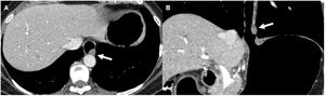 61-year-old woman being studied for a defect in oesophageal filling in the oesophagram, in a context of cough and heartburn. Axial (A) and coronal (B) reconstructions of Pneumo-CT with intravenous contrast. Nodular lesion in the left lateral wall of the distal oesophagus, with exophytic and endoluminal growth (arrow). The biopsy was positive for CD117, being compatible with a GIST.