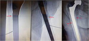 Femoroplasty technique. Image-guided monitoring. Patient aged 81 years. The fluoroscopic image shows that the vertebroplasty needle is located in the prosthetic stem area, with the bevel facing the area of interest. Different projections confirm the linear progression of the cement in the stem area during the cement injection (arrows).
