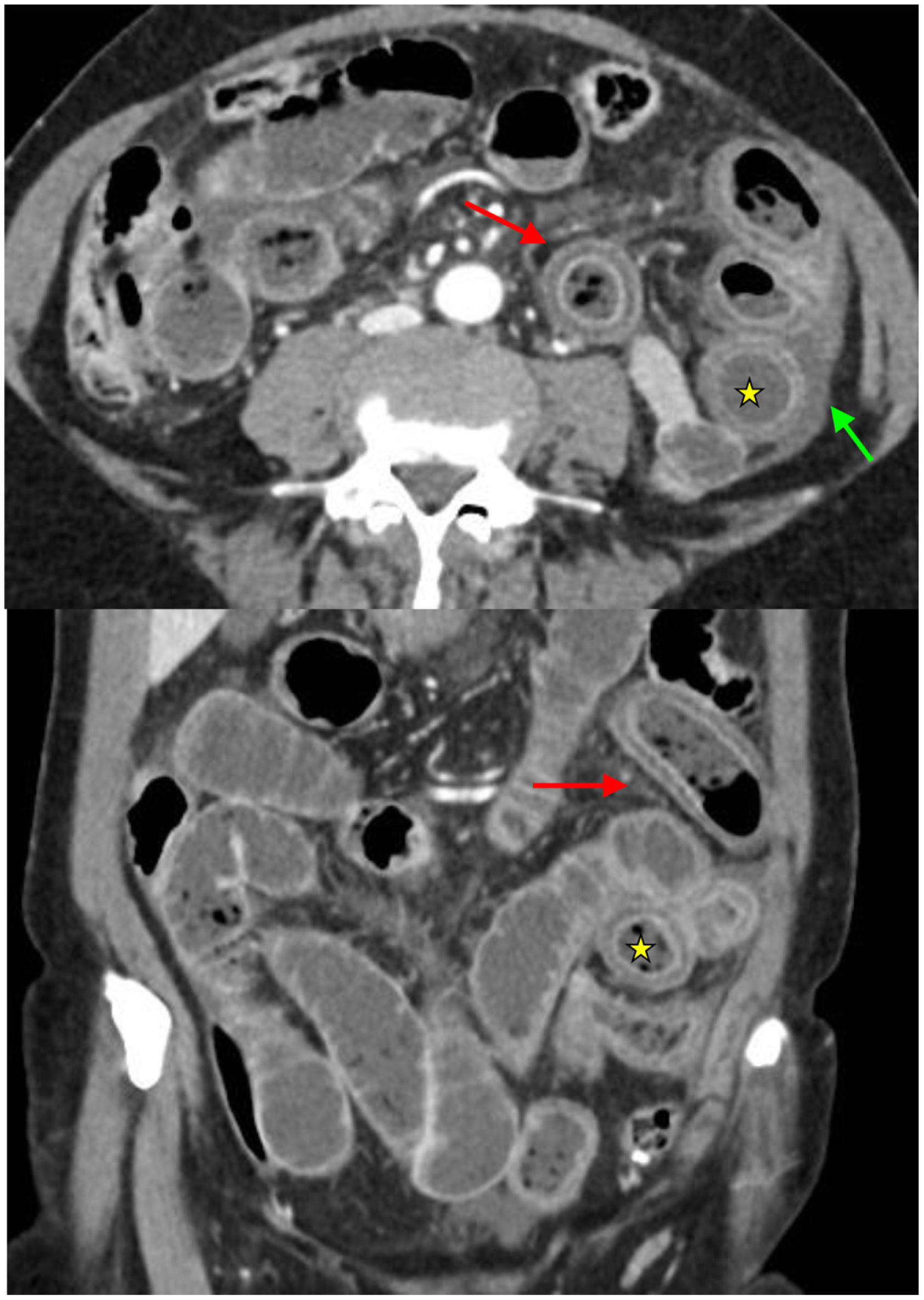 Bowel obstruction: signs indicating the need for urgent surgery ...