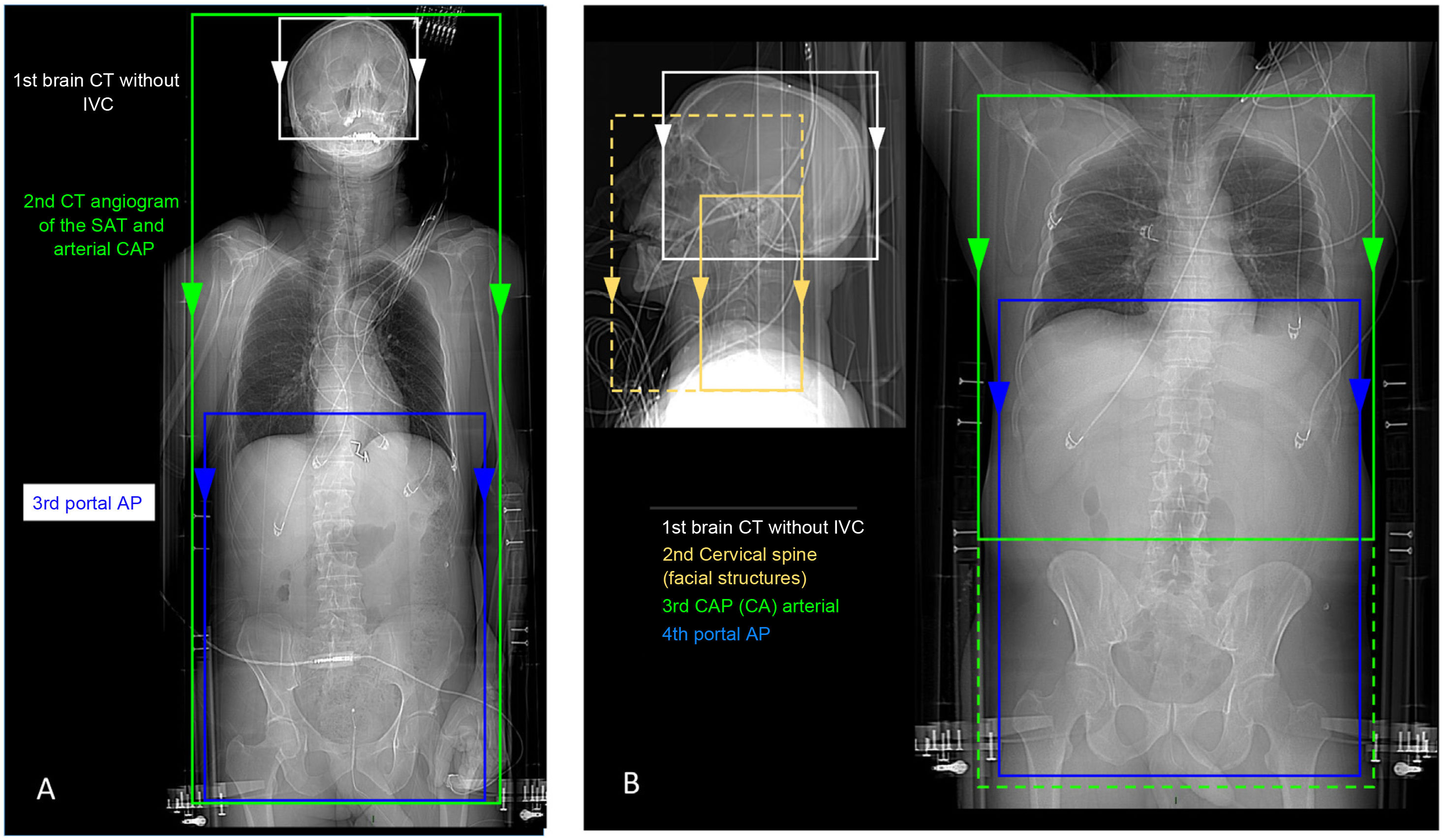 Patients with severe polytrauma: management and imaging protocols ...