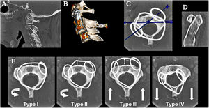 CT of cervical spine. (A) Cervical sagittal reconstruction showing a displaced Hangman type I fracture <2mm, without angulation (arrow). (B) Sagittal volumetric reconstruction of the same patient. (C) Normal postural rotation C1-C2, axial: a normal rotation angle of 40° is shown, between the transverse axes of C1 and C2 traced through the medial joint area of the lateral masses of the atlas and the articular facets superior to the axis. The rotational angle is obtained in the axial plane, evaluating C1 and C2 simultaneously in the same image using the maximum intensity projection (MIP) post-processing technique. (D) C1-C2 normal postural rotation, sagittal reconstruction in the midline: there is no anterior displacement of C1 with respect to the dens (arrow). (E) Fielding classification. Anterior displacement of C1 (arrows). Type I: unilateral displacement of one of the C1 masses without displacement of the anterior arch of the atlas with respect to the dens (3mm, normal in adults). Type II: unilateral anterior displacement of one of the C1 masses with displacement of the anterior arch of the atlas with respect to the dens of 3–5mm. Type III: anterior displacement of both lateral masses of the atlas with displacement of the anterior arch with respect to the dens >5mm. Type IV: posterior displacement of C1, pathological or insufficient dens (os odontoideum, hypoplastic or fractured dens).