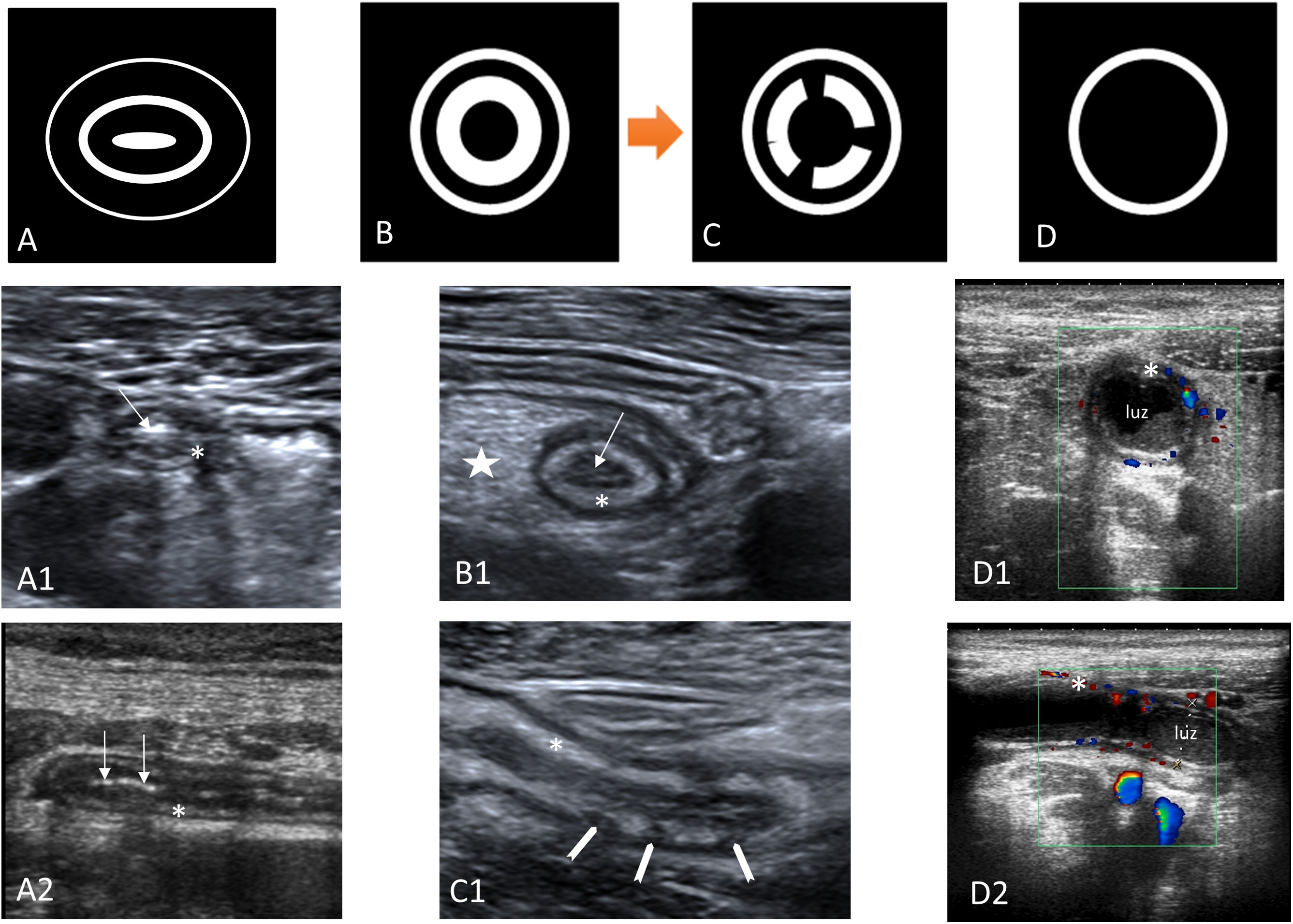 Update on acute appendicitis: Typical and untypical findings ...