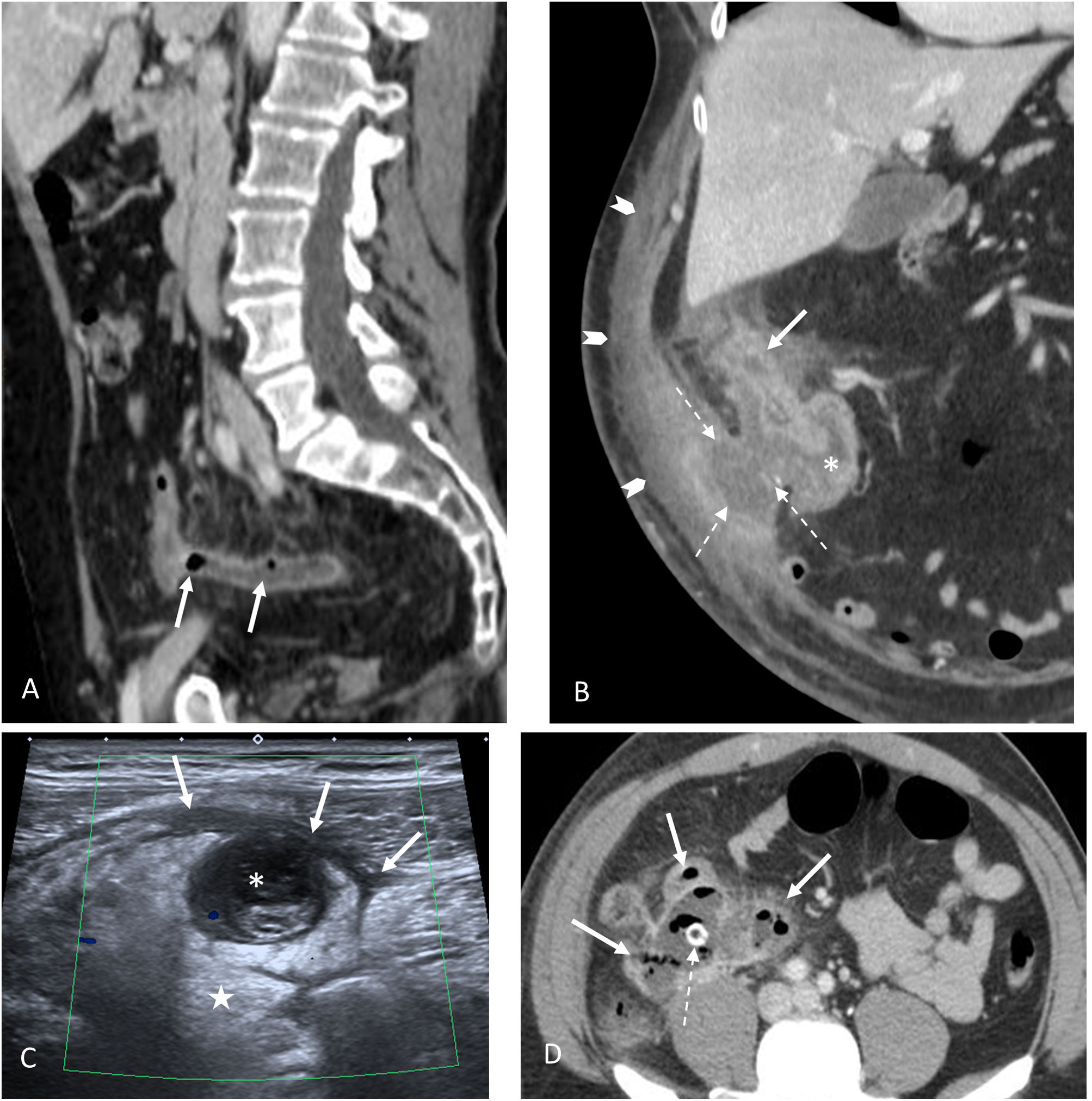Update on acute appendicitis: Typical and untypical findings ...