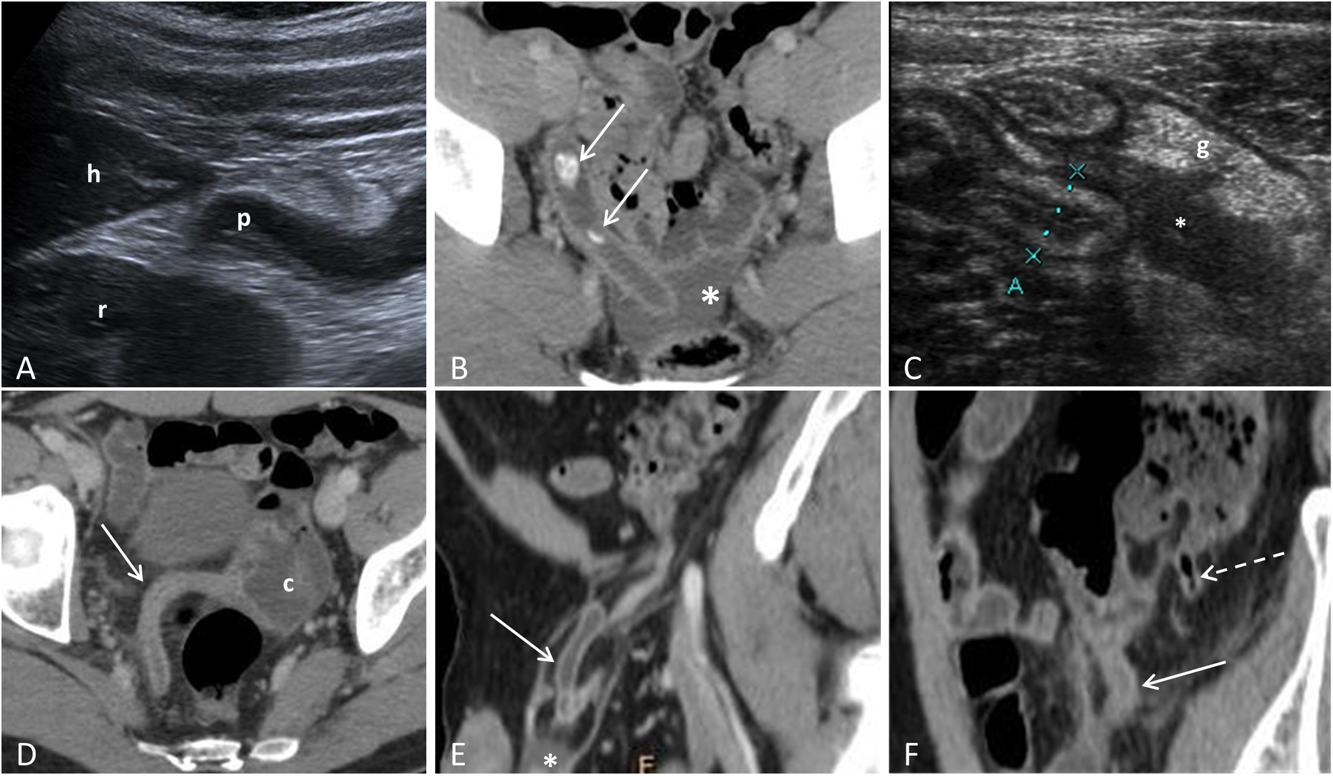 Appendix Imaging Update on acute appendicitis: Typical and untypical findings ...