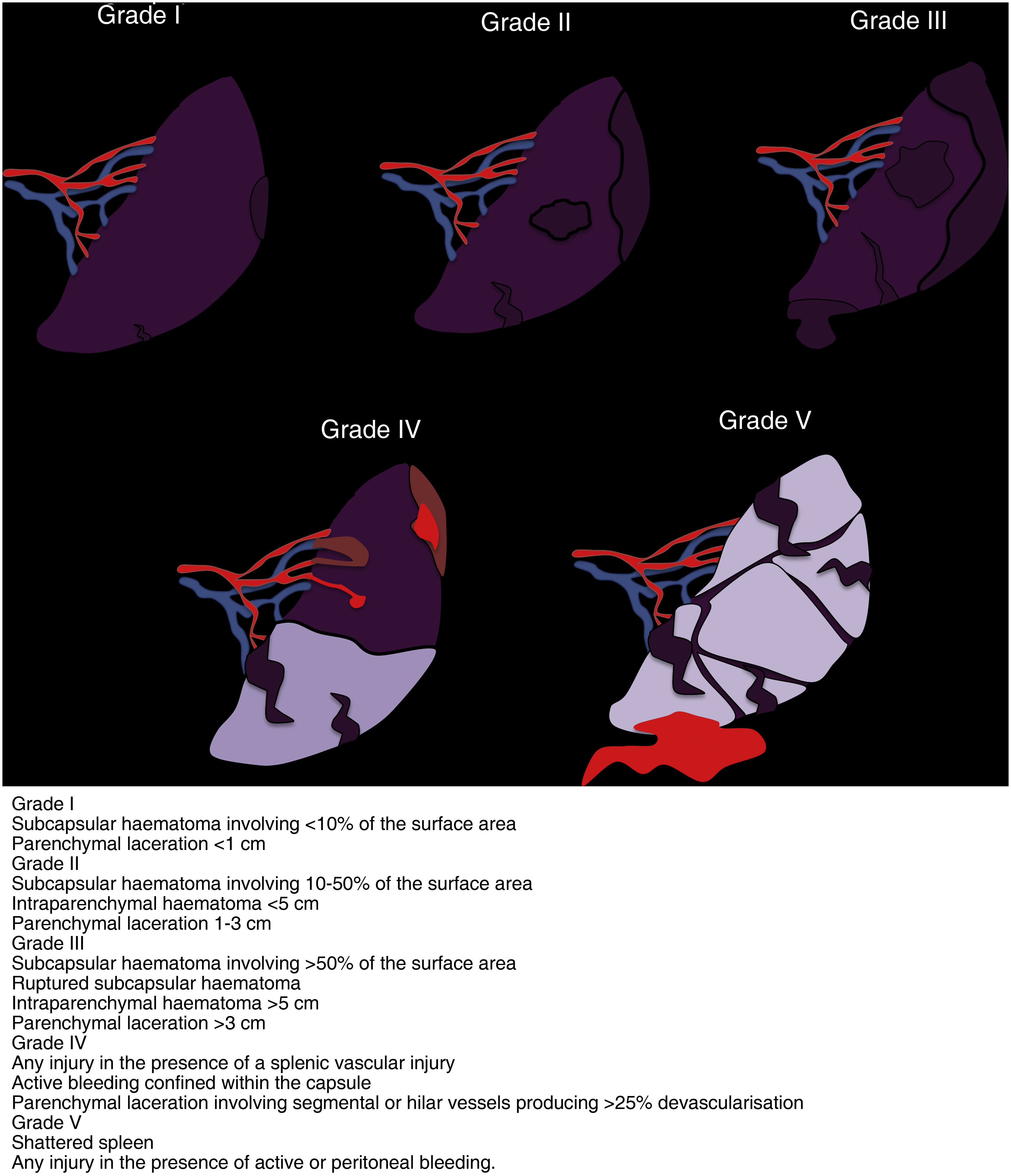 Splenic Injury Classification Abdominal trauma | Radiología (English Edition)