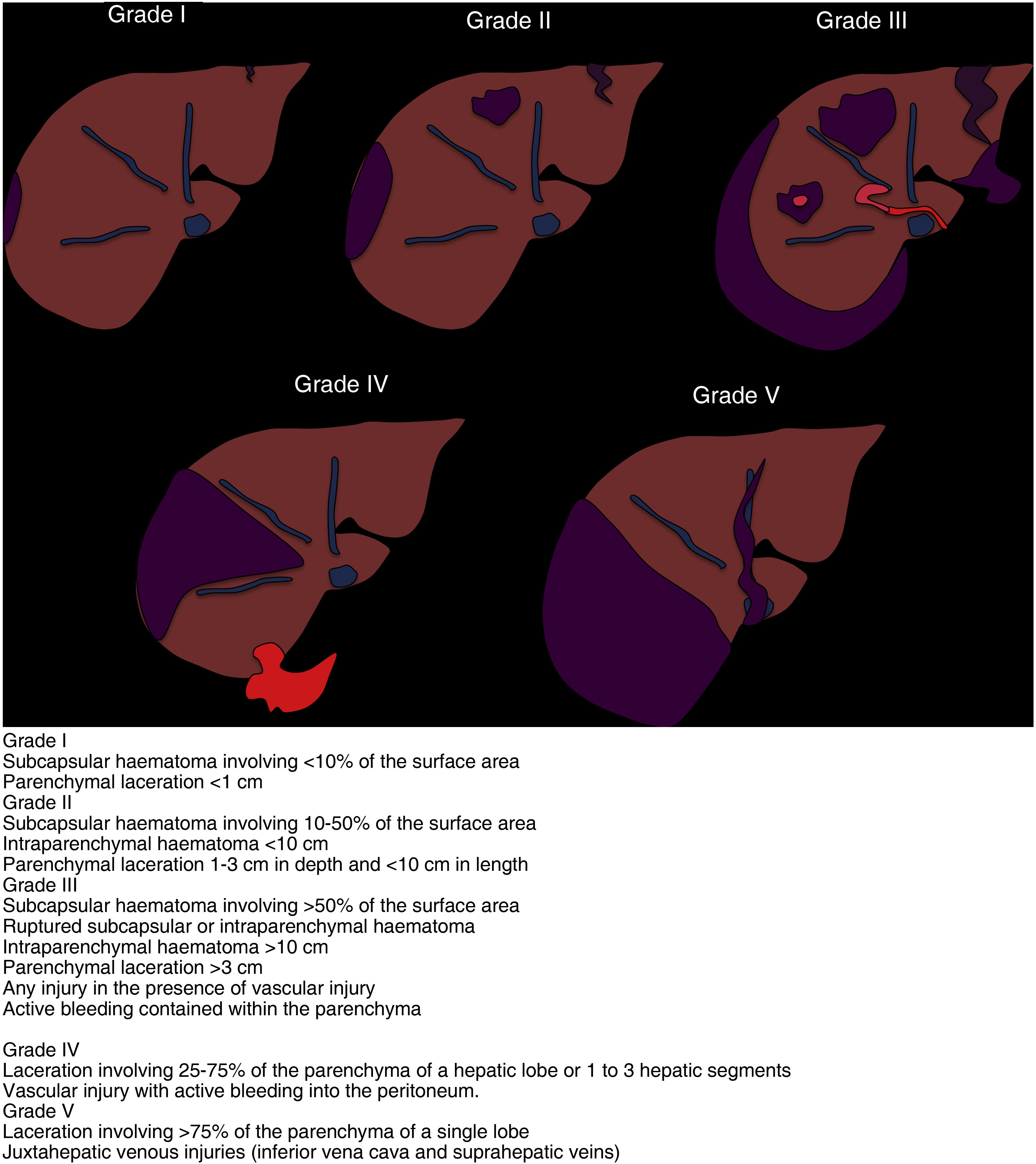 Aast Classification Abdominal trauma | Radiología (English Edition)