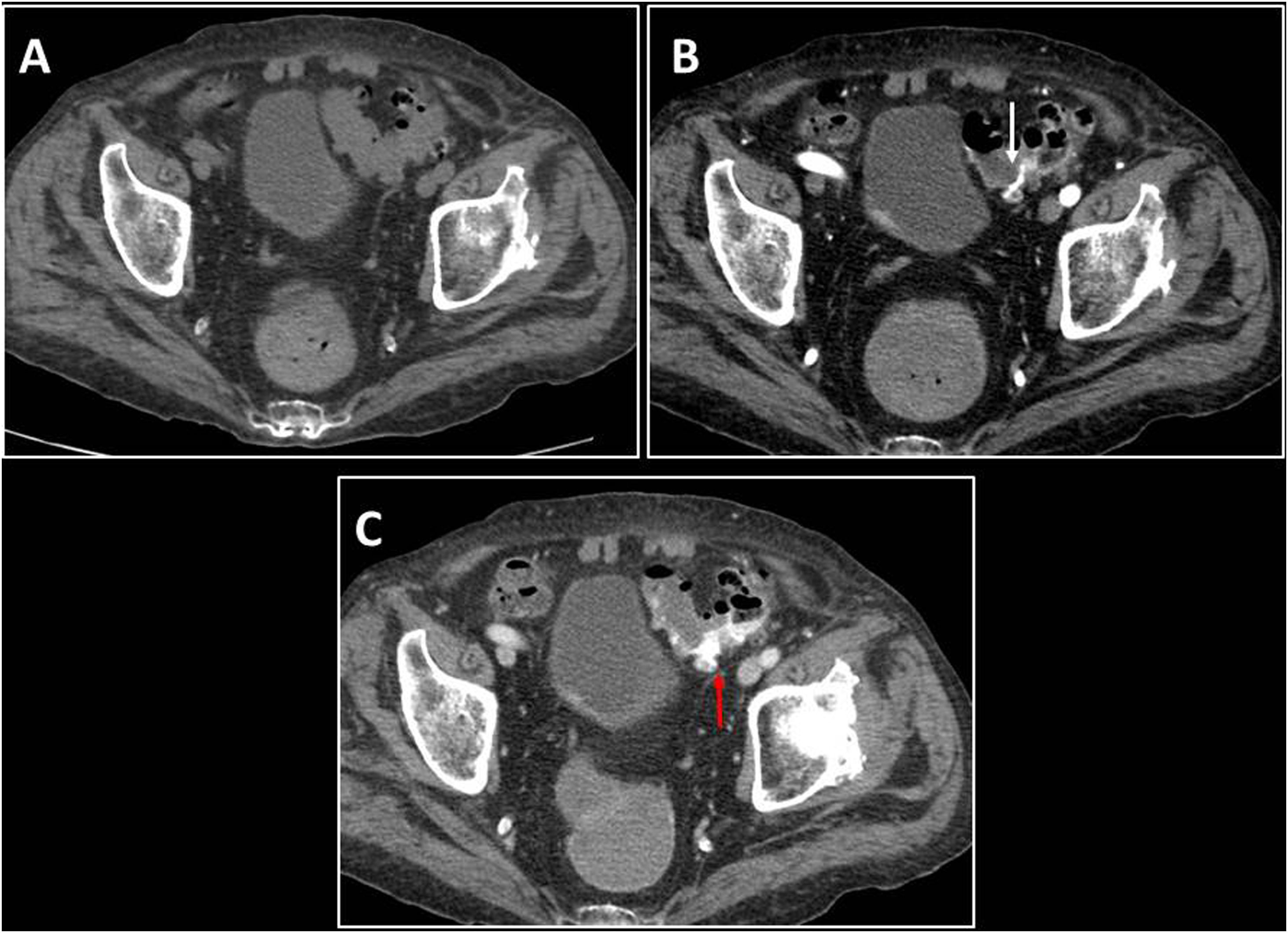 Internal Bleeding Images Non-traumatic spontaneous abdominal haemorrhage | Radiología (English ...