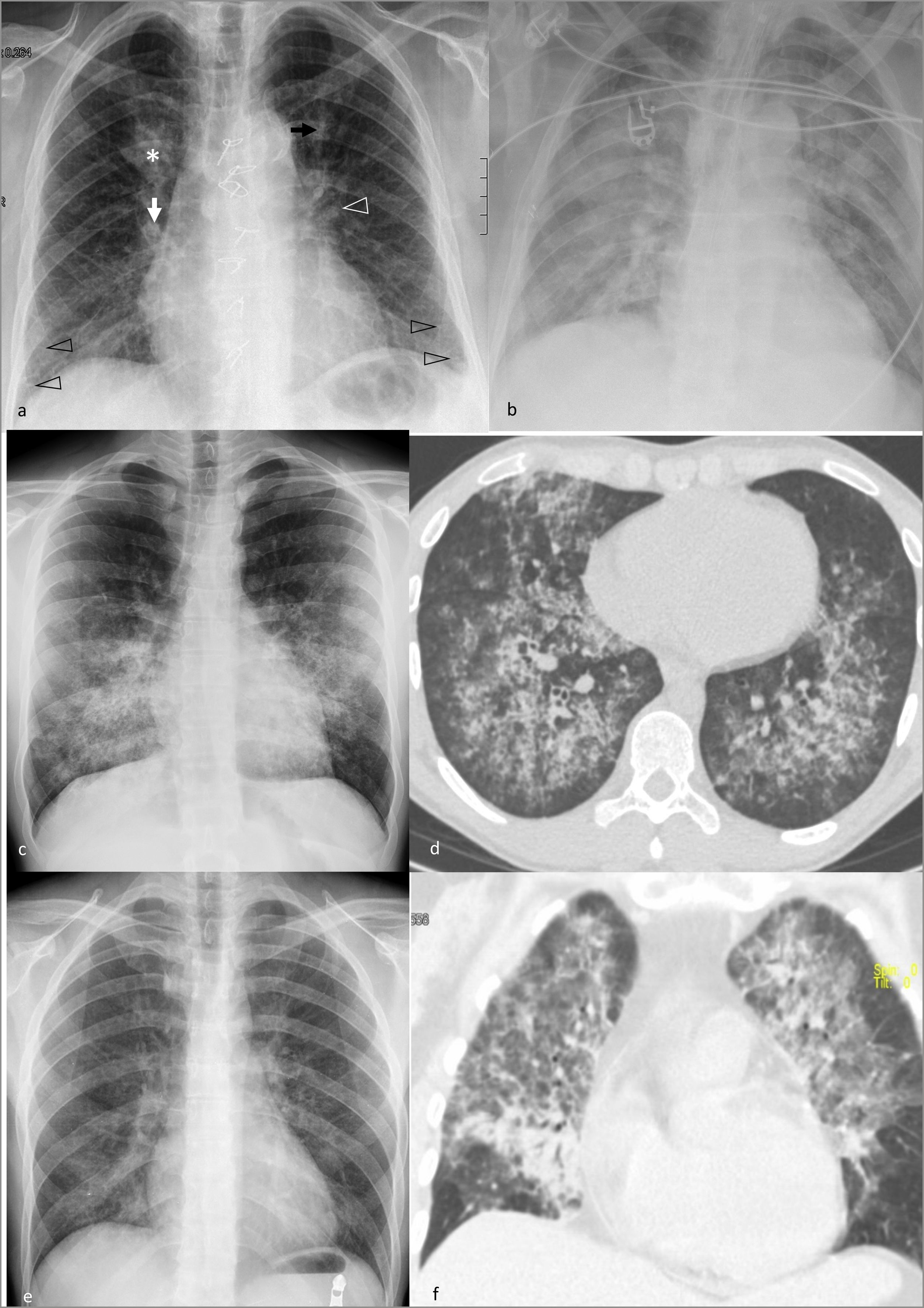 Schematic approach to the diagnosis of multifocal lung opacities in the ...