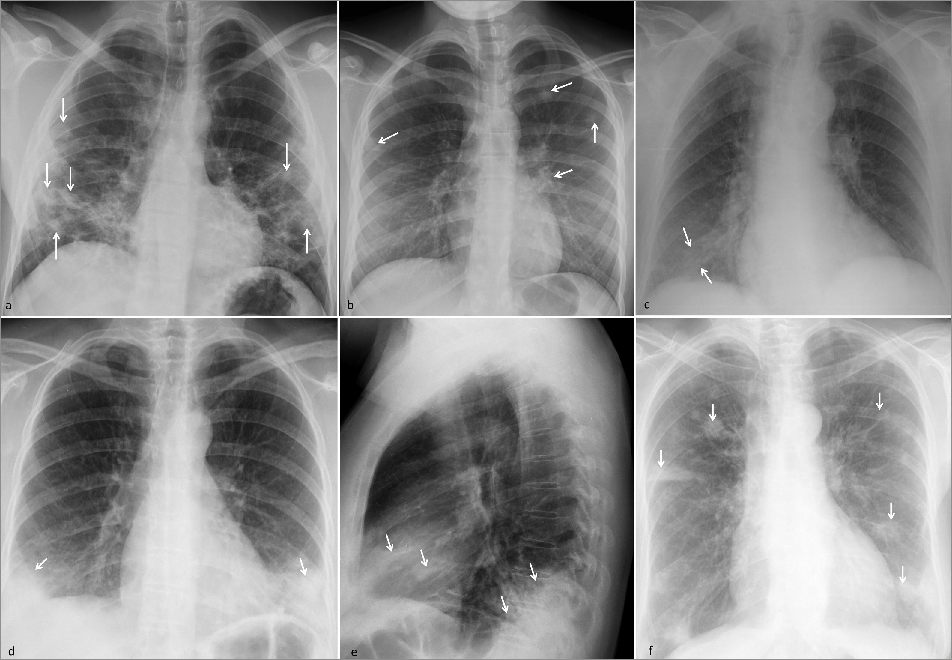 Schematic approach to the diagnosis of multifocal lung opacities in the ...