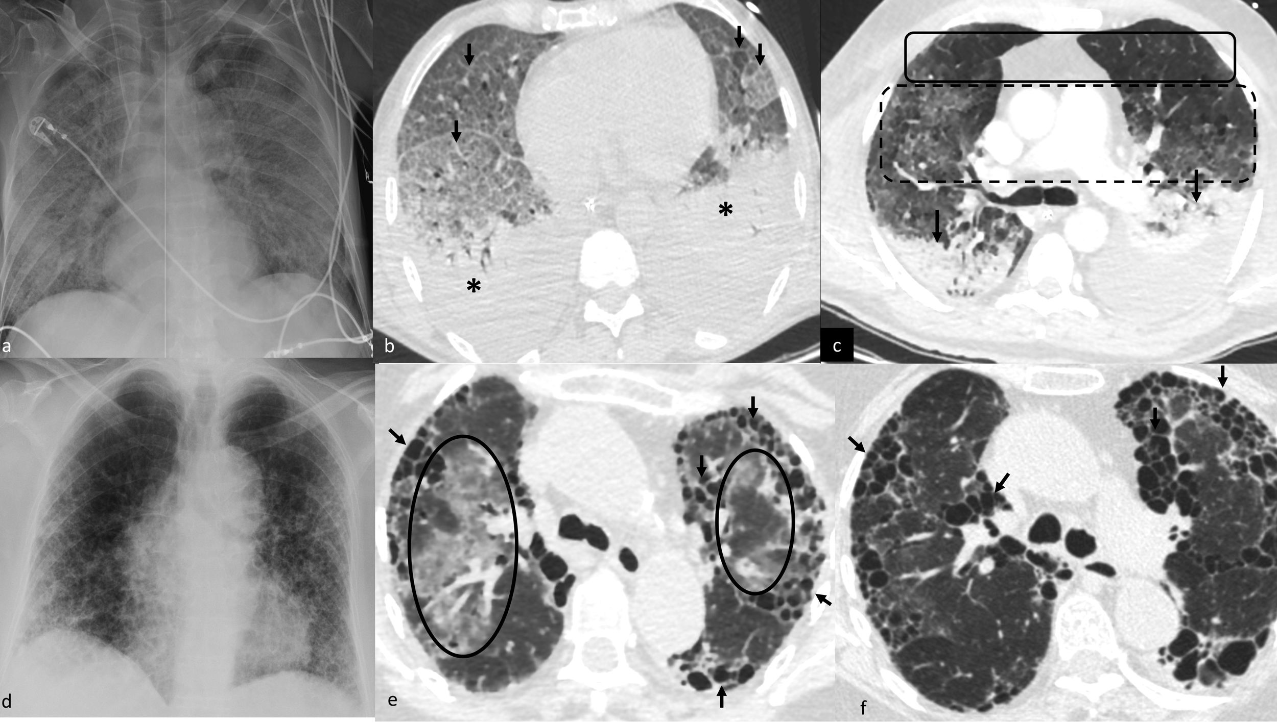 Schematic approach to the diagnosis of multifocal lung opacities in the ...