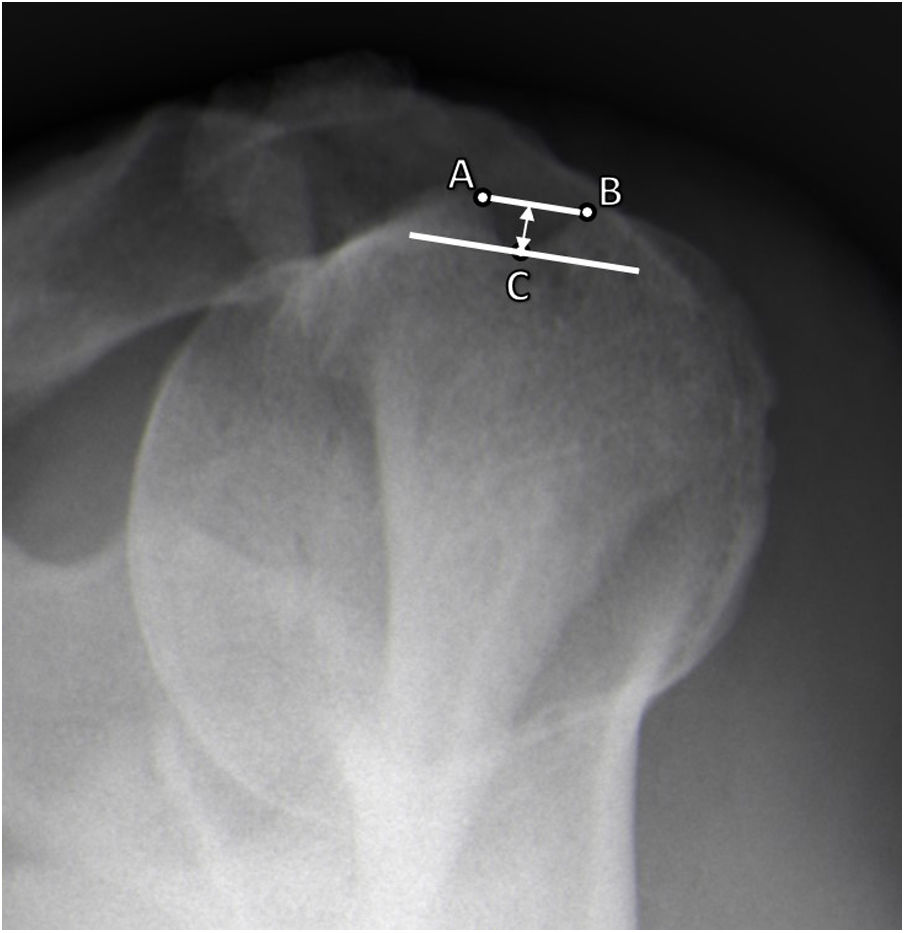 Radiographic evaluation of the bicipital groove morphology does not ...
