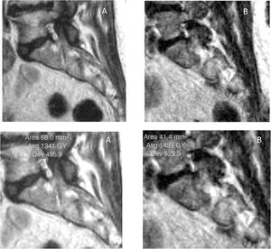 Sagittal slices in supine (A) and standing (B) at the level of the right L5-S1 foramina. Reduction of area when standing.