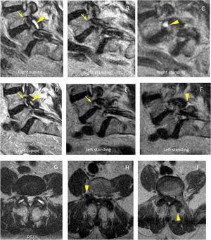 Bilateral foraminal stenosis associated with instability with L4-L5 facet joint degeneration. (A) Sagittal slice in supine position at the level of the right foramen, with foraminal stenosis (arrow), thickening of the ligamentum flavum and facet joint fluid (arrowhead). (B) Sagittal slice in standing position at the same level, with the foramen of similar size (arrow), not visualising the image of facet joint fluid at that level. At a more lateral parasagittal level (C), an extraforaminal cyst can be seen, an expression of the displacement of the facet joint fluid. (D) Sagittal slice in supine position at the level of the left foramen, with foraminal stenosis (arrow) as well as facet joint fluid (arrowhead). (E) Sagittal slice in standing position at the same level, with the foramen of similar size (arrow), with the synovial joint fluid at that level not clearly visible. At an adjacent level (F), posterior fluid displacement is visible (arrowhead). (G) Axial slice in supine. (H) Axial slice with T1-weighted sequence in standing position at a lower level, where the right-sided displaced cyst is evident (arrowhead). (I) Lower consecutive slice in standing position, with visualisation of the left-sided fluid displaced posteriorly (arrowhead).