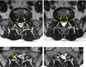 Axial slices at the level of the posterior disc margin L5-S1 in supine (A) and standing (B). Reduction of both lateral recesses (arrows), even at a lower level a right posterior-medial hernia is visible (C, arrowhead) which does not increase significantly in standing position (D, arrowhead). In the standing sections, the increase in CSF and the greater diameter of the dural sac (B and D) can be seen.