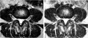 Axial slices of the L4-L5 disc at the level of the posterior disc margin in supine (A) and standing (B). Slight reduction in lateral recesses. Limited tolerance of the standing test leads to motion artifacts.