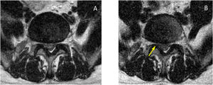 Axial slices with sp T2 in supine (A) and standing (B). Low-signal material corresponding to nucleus pulposus forming a large central disc herniation that occupies a large part of the spinal canal slice. Greater involvement of the right recess in standing position (arrow), with less impact on the left recess and without significant changes in hernia dimensions.