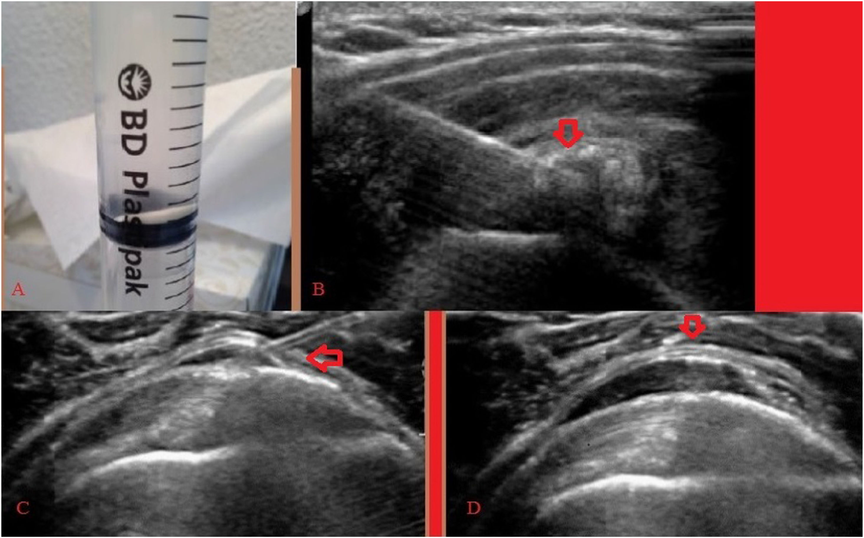 Treatment of calcific tendinopathy of the rotator cuff with ultrasound ...