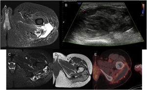 A) Axial T2-weighted image: hyperintense collection, with discrete variations in size over seven years, compatible with seroma. B) Ultrasound: lobulated lesion with well-defined borders, with a thick peripheral capsule and markedly heterogeneous content, without vascularisation on colour Doppler study. C) Axial T1-weighted image: increased signal intensity on T1-weighted sequences (*), corresponding to methaemoglobin and images compatible with clots. Peripheral capsule of tissue that is most likely fibrotic, markedly hypointense on all pulse sequences (→). D) MRI three months later; decreased signal on T1-weighted sequences suggesting subacute-chronic evolutionary changes of methaemoglobin, as well as mild clot growth. Hypointense peripheral capsule (→). E) The PET-CT study shows increased peripheral glucose metabolism, suggestive of an inflammatory process.