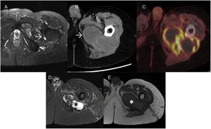 A) MRI heterogeneous collection with hypodense capsule (→). B) CT: predominantly hypodense collection, with peripheral enhancement (→). C) PET: peripheral hypermetabolic component observed. D and E) Post-surgical MRI: less voluminous collection and increased signal hyperintensity on T2 (*), corresponding to partial resection and new CEH formation.