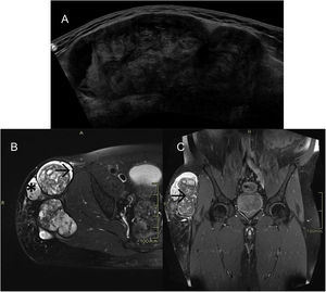 A) Ultrasound and B) MRI: lesion in the subcutaneous cellular tissue of the lateral aspect of the pelvis and root of the right thigh, polylobulated, surrounded by a markedly hypointense thick capsule (→) on all sequences. The content is highly heterogeneous, with a hyperintense component (*) on the T1-weighted sequences. C) After intravenous contrast administration, central filiform enhancement is seen (→), with no peripheral or nodular enhancement.