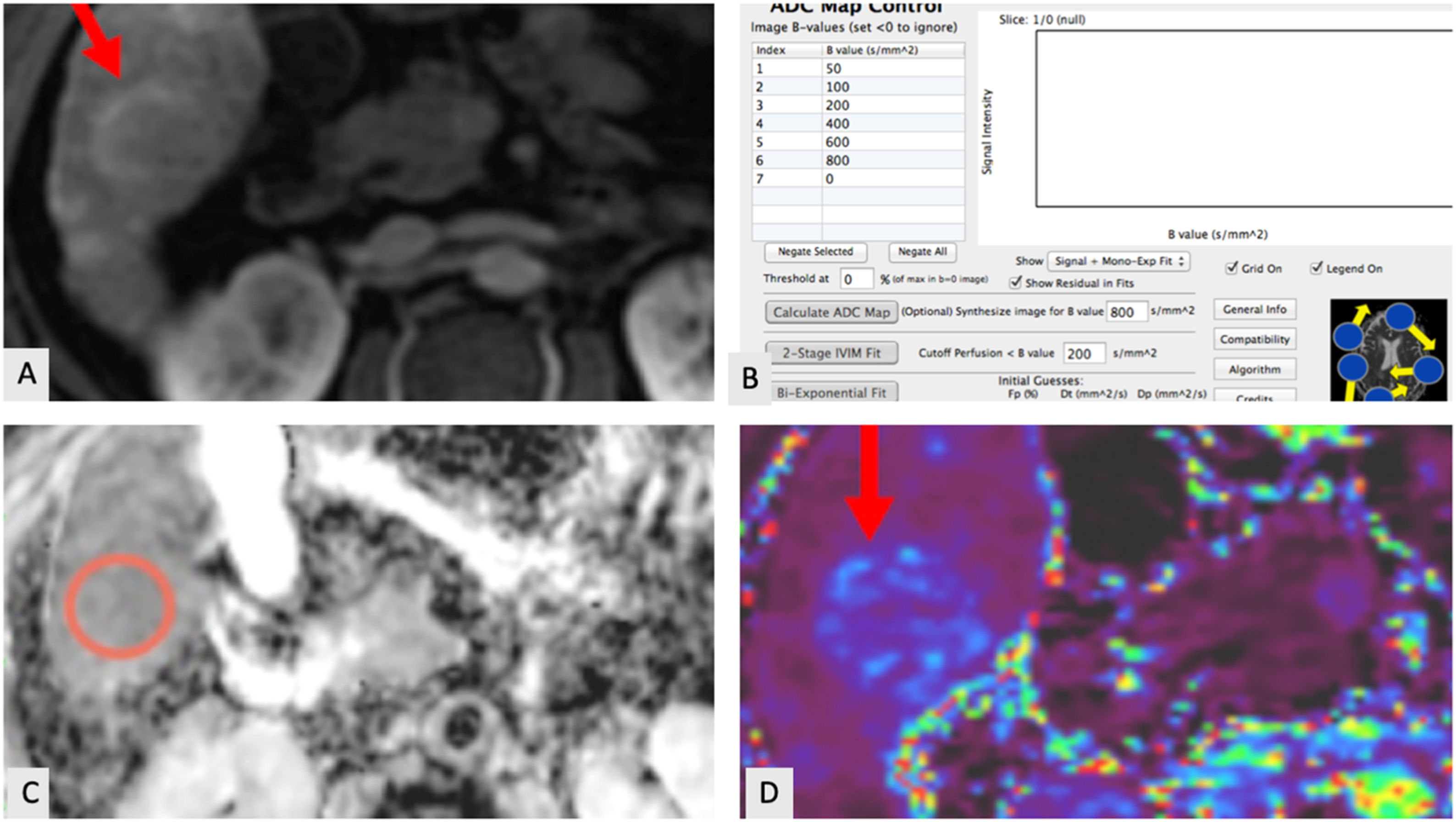 Role of intravoxel incoherent motion (IVIM) imaging in response ...