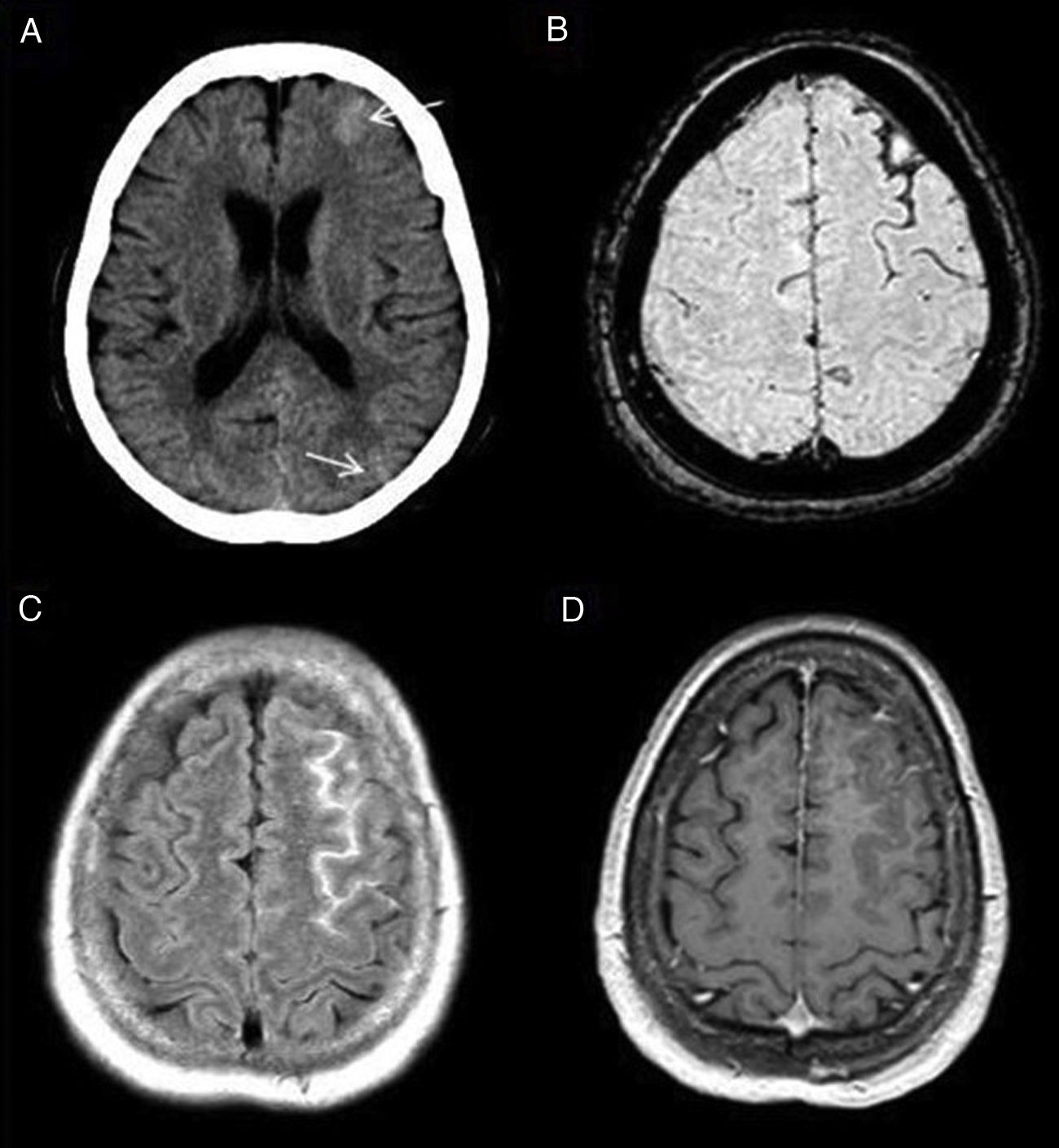 FLAIR hyperintensity in the subarachnoid space: Main differentials ...