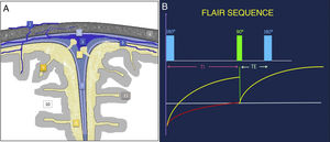 Anatomical illustration of the subarachnoid space and meningeal layers (A). FLAIR sequence acquisition diagram (B). By applying an initial inversion pulse of 180° and using a long TI prior to the initial excitation pulse of 90°, the signal of structures that have a long relaxation time, such as the CSF, can be suppressed. FLAIR: fluid-attenuated inversion recovery; TE: echo time; TI: inversion time; 1: superior sagittal sinus; 2: emissary and diploic veins; 3: pial cerebral veins; 4: skull; 5: dura mater; 6: arachnoid granulations; 7: interhemispheric fissure; 8: subarachnoid space; 9: sulci of the cerebral convexity; 10: cerebral white matter; 11: cerebral grey matter. Courtesy of Dr Javier Lafuente Martínez.