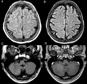Oxygen therapy artifact. Patient who was receiving supplemental oxygen. The FLAIR sequence (A) shows a very faint and diffuse increase in CSF intensity in the frontoparietal convexity sulci that disappeared in the control MRI after withdrawal of oxygen therapy (B). Artefact due to vascular pulsatility. Pulsatility artefact in the cistern of the bulbocerebellar angle on the left side (C), produced by the throbbing of the basilar artery, simulating a lesion. This image is not identified in the T1-weighted sequence with IVC (D).