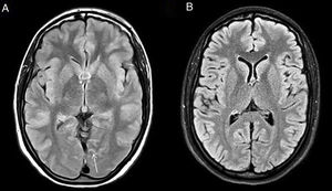 HaNDL. Axial FLAIR image (A) showing faint hyperintensity in the occipital paramedian sulci (arrows). In the control SPIR FLAIR MRI (B) one month later, these findings disappeared.