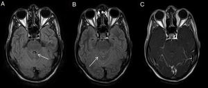 Cryptococcal meningitis. Patient with HIV infection. FLAIR sequence (A) shows a faint signal enhancement adjacent to the cerebellar folia, more evident in FLAIR sequence with intravenous contrast (IVC) (B) and difficult to visualise in T1 with IVC and magnetisation transfer.