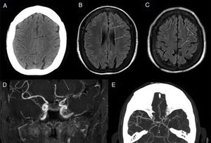 Moyamoya disease. 60-year-old woman with stenosis of major intracranial vessels, with Moyamoya pattern. Cranial CT scan without IVC (A) shows small ischaemic lesions (black arrow) of undetermined chronology in the subcortical border zone. FLAIR images (B and C) show discrete linear signal hyperintensity in the adjacent convexity sulci (white arrows), reflecting the increased pial collaterality. MRI angiography (D) confirms stenosis of the supraclinoid segment of the left internal carotid artery (ICA) and M1 segment of the left middle cerebral artery (MCA) (white arrow). CT angiography (E) also shows the proliferation of a deep vascular network surrounding the stenosed segments (white arrow).