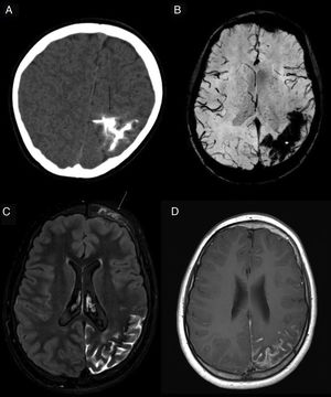 Sturge-Weber syndrome. Extensive gyral and leptomeningeal calcification (black arrow) in the left parietal lobe, visualised on cranial CT scan without IVC (A). Control MRI 5 years later (B-D): T2* FFE sequence (B) shows susceptibility artefact (*) caused by calcifications; FLAIR sequence (C) and T1 after IVC administration show focal cortical atrophy, SAS hypersignal and leptomeningeal enhancement (white arrow in D) in the sulci of the left parietal convexity, reflecting the leptomeningeal venous malformation typical of this disease. Frontal hyperostosis and subtle cutaneous hyperintensity corresponding to the port-wine stain on the left side (white arrow in C) are also seen. Courtesy of Dr Lancharro Zapata and Dr Aguado del Hoyo.