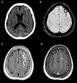 Subarachnoid haemorrhage (SAH). The CT image shows a faint hyperdensity in the left superior frontal and left parieto-occipital sulci (arrows) in relation to non-traumatic SAH (A). The haematic content of the superior frontal and prerolandic sulci produces a susceptibility hypointensity in the T2*FFE sequence (B) and a hyperintensity in the FLAIR sequence (C). No enhancement on T1 sequence with IVC (D). No aneurysms or vascular anomalies were found on digital subtraction angiography.