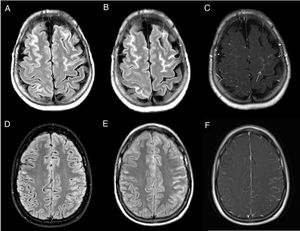 Leptomeningeal carcinomatosis. Patient with a history of lung cancer with signs of leptomeningeal dissemination with signal hyperintensity in bilateral frontoparietal convexity sulci on FLAIR imaging (A), which show enhancement with intravenous contrast in both the FLAIR sequence with contrast (B) and in gadolinium-enhanced T1 with magnetisation transfer (arrow in C). Secondary leptomeningeal melanosis. Patient with metastatic melanoma with signs of bilateral leptomeningeal infiltration on SPIR FLAIR images (arrows in D) and with areas of leptomeningeal uptake on FLAIR (E) and gadolinium-enhanced T1-weighted sequences with magnetisation transfer (F).