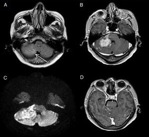Secondary leptomeningeal lymphomatosis by contiguity. The FLAIR image (A) shows hyperintensity in the sulci between the cerebellar folia (arrow) due to leptomeningeal infiltration contiguous to a cerebellar lymphomatous mass showing intense enhancement on the gadolinium-enhanced T1-weighted sequence (B) and diffusion restriction (C). Leptomeningeal involvement shows uptake in the T1-weighted sequence after Gd administration (D).