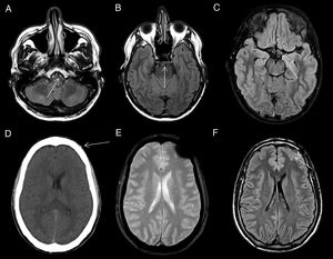 CSF pulsatility artifact. Axial FLAIR images show non-pathological CSF signal hyperintensity in the peribulbar (A), prepontine (B) and suprasellar (C) cisterns. Magnetic susceptibility artifact. The CT image (D) shows a millimetre-sized foreign body of metallic density in the subcutaneous cellular tissue (arrow) causing a magnetic susceptibility artefact on T2* gradient-echo sequences (E) and a linear signal hyperintensity artefact on FLAIR (F) in the underlying subarachnoid space (arrow).