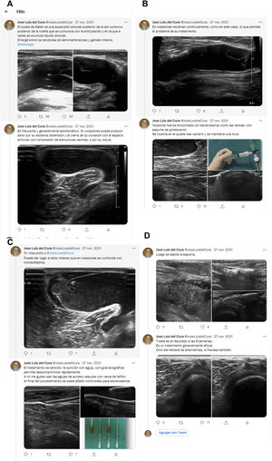 Twitter feed of a musculoskeletal interventional procedure.
