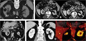 Multiple sporadic bilateral renal tumours that are histologically concordant. (A) Bilateral lipomas or angiomyolipomas with an almost exclusively fatty component (arrows) were found incidentally on non-contrast CT in a 65-year-old man with no other clinical or radiological features suggestive of tuberous sclerosis. (B) Bilateral papillary renal cell carcinoma (pRCC). A 78-year-old male, under follow-up for a mildly hyperattenuating left renal tumour found incidentally in a non-contrast study with low enhancement (study not shown). In the follow-up examination (left; axial composite image) moderate growth is observed (arrow), with another contralateral lesion (dashed arrow) going unnoticed. A partial left nephrectomy was performed. Image from another follow-up examination two years later (right) shows the area that underwent the partial nephrectomy (hollow arrow) and the contralateral lesion which has grown (dashed arrow). An ultrasound-guided core needle biopsy was performed. The histological result in both cases was pRCC, which was then classified as type 1. The patient opted for active surveillance, and slight growth of the right lesion was observed in the only follow-up examination, performed one year later (not shown). (B) Bilateral clear cell renal cell carcinoma (ccRCC). A 67-year-old male with haematuria. CT scan in the nephrographic phase shows an upper right renal lesion (arrows) with intense enhancement peaking in the corticomedullary phase (not shown) and central areas of necrosis, corresponding to a ccRCC pT3 pN1 after nephrectomy, and a smaller lower left lesion (arrow) with intense and slightly heterogeneous enhancement. This lesion was removed and histologically confirmed as pT1a. No germline mutation for Von Hippel-Lindau was detected and there were no other tumours in the right nephrectomy specimen. (D) Bilateral oncocytic neoplasms in a 75-year-old male. Incidental finding of two small upper lesions with moderate enhancement on average coronal image of spectral acquisition in nephrographic phase (arrows), with iodine density of 3.1 mg/mL on the iodine map of the same study in the right lesion, 4.6 in another ipsilateral lesion, and 3.2 in the left lesion (not shown). A core needle biopsy was performed on the right lesion, which resulted in an oncocytic diagnosis. The same histology was assumed for the rest of the lesions which behaved similarly. The result from the single-gene test for Birt-Hogg-Dubbé was negative. The patient opted for active surveillance.
