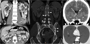 Tuberous Sclerosis Complex in a 45-year-old female. CT. Innumerable bilateral renal angiomyolipomas with gross fat. Its exophytic growth is noteworthy due to the risk of bleeding associated with its size and the abundance of aberrant vessels, one of which is in the lower pole of the left kidney (arrow). Hepatic angiomyolipomas are also visible (double arrow), along with sclerotic lesions in the axial skeleton (arrowheads), small subependymal calcified lesions (hollow arrows) and multiple thin-walled cystic lesions in both lungs (dashed arrow) in the context of pulmonary lymphangioleiomyomatosis.
