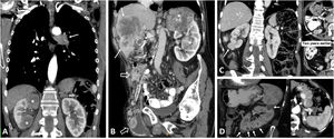 Renal metastases and mimics. (A) Renal metastases of squamous-cell carcinoma of the lung (arrow), exhibiting multiple renal masses with poor enhancement and infiltrative behaviour (*). (B) Renal metastases of adenocarcinoma of the gallbladder with extensive infiltration of the adjacent liver parenchyma (arrows) and extensive peritoneal carcinomatosis, also within an inguinal hernia (hollow arrows). The renal lesions (*) behave similarly to the primary neoplasm, with moderately intense and heterogeneous enhancement, and abundant tumour necrosis. In this case, the lesions have a more expansive behaviour. (C) Clear cell renal cell carcinoma mimicking breast carcinoma metastasis in a 64-year-old woman undergoing oncological follow-up due to her medical history. Exophytic, expansive renal cortical lesion with enhancement almost as intense as that of the parenchyma (arrows). A retrospective review of previous studies showed that it was present in a study performed two years earlier (dashed arrow), with slower growth than expected for metastasis. The diagnosis was confirmed following percutaneous biopsy and tumour removal. (D) Contralateral renal metastases of clear cell carcinoma (ccRCC) or Von Hippel-Lindau? An 82-year-old female underwent a right nephrectomy for ccRCC. CT images show numerous markedly enhancing contralateral renal nodules with cystic appearance and thick walls, which is the usual appearance of lesions in Von Hippel-Lindau syndrome. However, hypervascular metastases coexisted in both the left adrenal region (arrowhead) and lung (not shown). The patient died without a confirmatory genetic diagnosis.